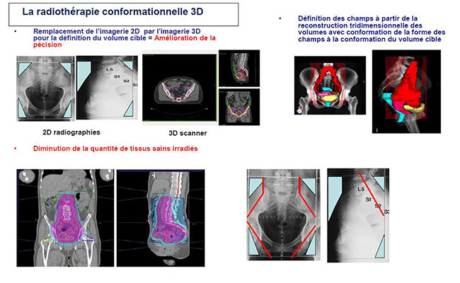 La radiothérapie conformationnelle 3D