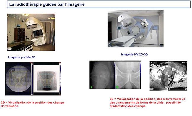 La radiothérapie guidée par l'imagerie