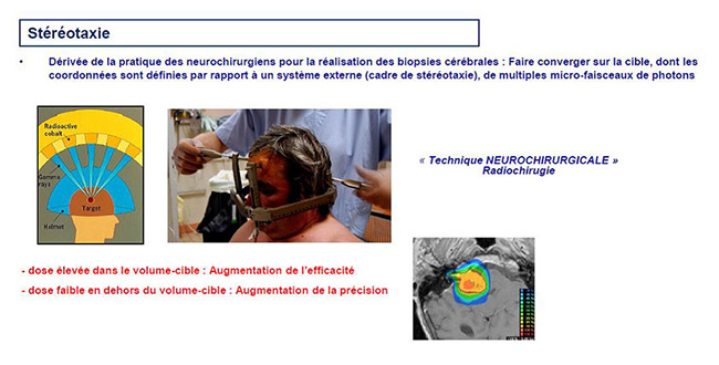 La stéréotaxie