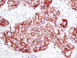 Mise en évidence de la surexpression d’HER2 par Immunohistochimie