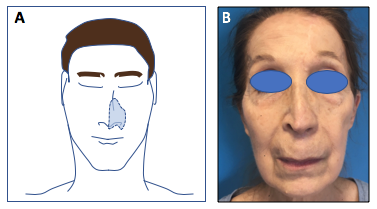 CHRU de Tours. Chirurgie Maxillo-Faciale, Plastique et Brûlés ...