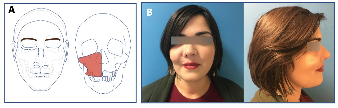 CHRU de Tours. Chirurgie Maxillo-Faciale, Plastique et Brûlés ...