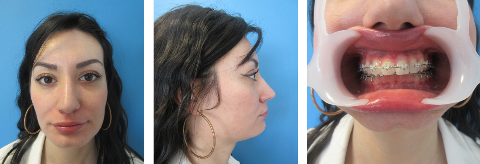 CHRU de Tours. Chirurgie Maxillo-Faciale, Plastique et Brûlés. Chirurgie orthognathique.