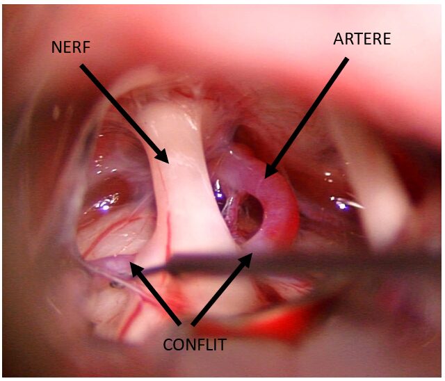 Conflit vasculo-nerveux