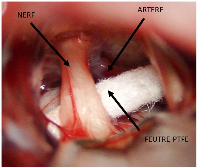 Conflit vasculo-nerveux