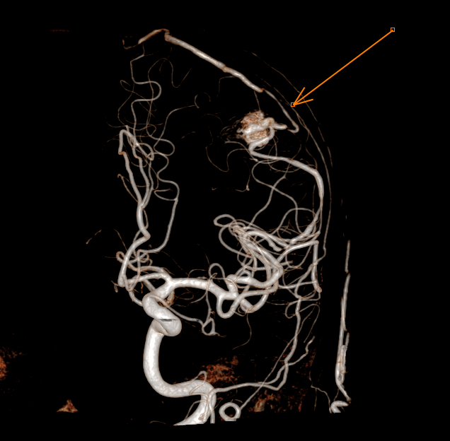 Malformations artério-veineuses (MAV)