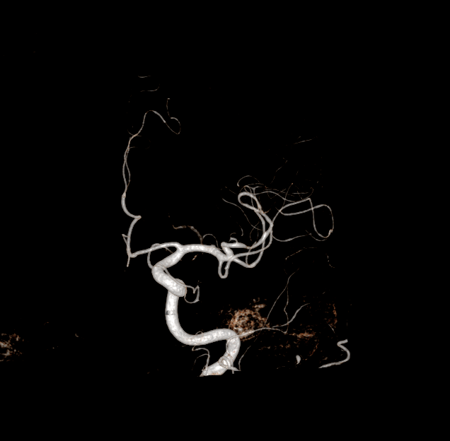 Malformations artério-veineuses (MAV)