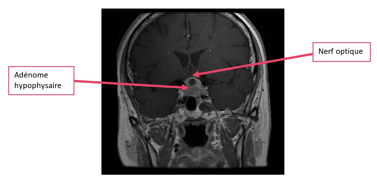 adénome hypophysaire