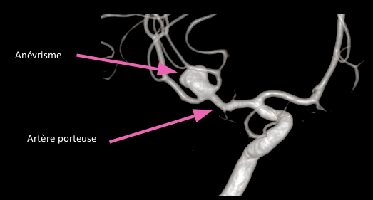 anévrisme intracrânien