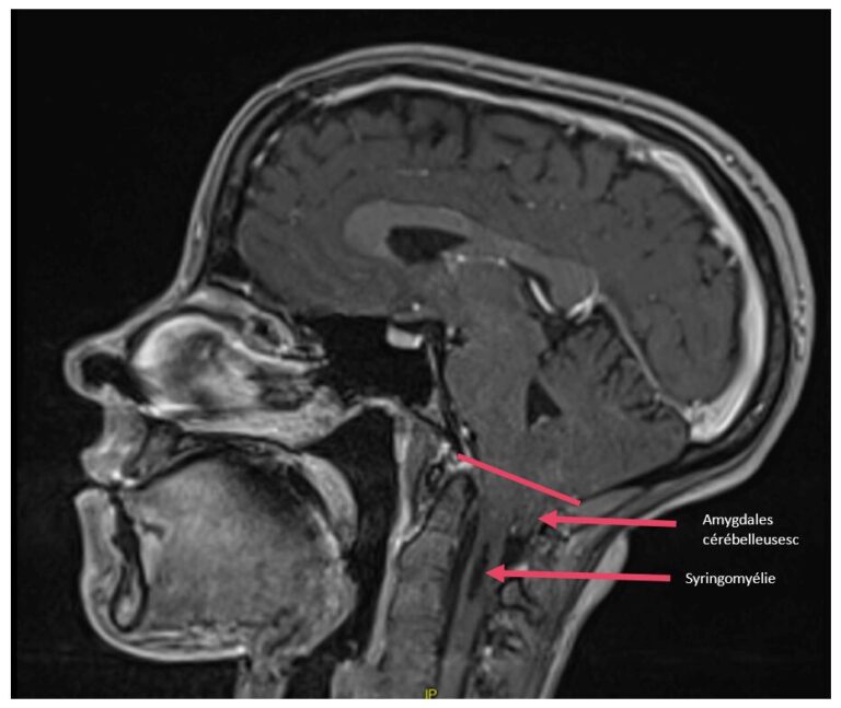 malformation d’Arnold-Chiari