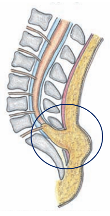 lipome du cône terminal