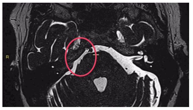 névralgie trigéminale