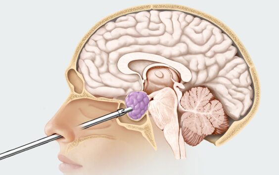 Technique chirurgicale par voie endonasale