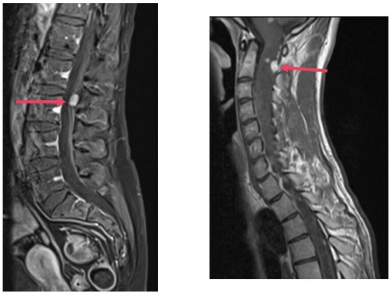 Tumeurs rachidiennes