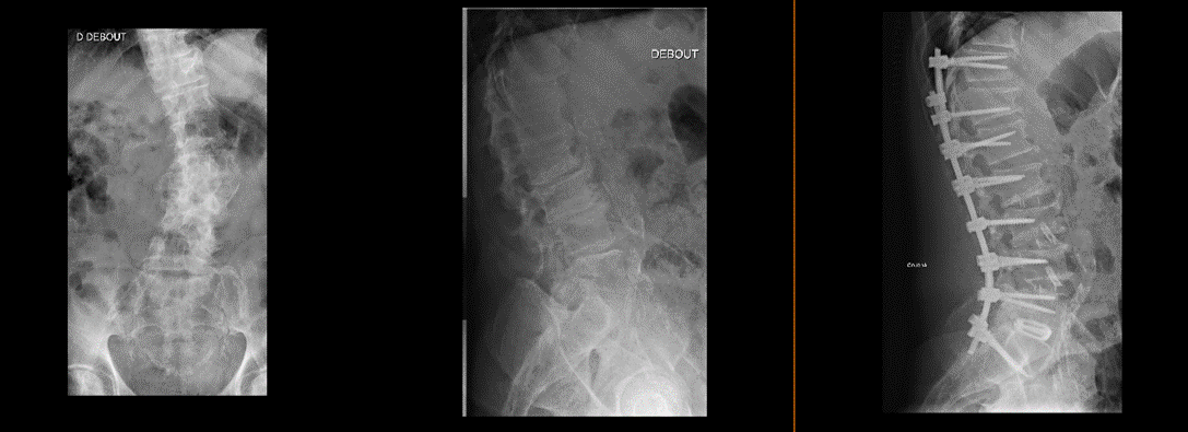 Radiographie pré et post opératoire d’une arthrodèse pour correction de scoliose