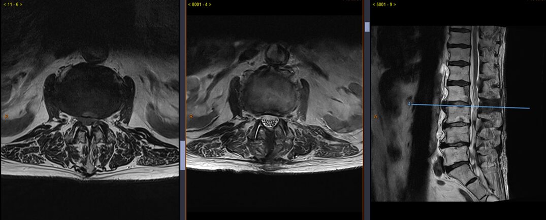 Sténose du canal lombaire L2-L3 avant et après chirurgie de décompression.