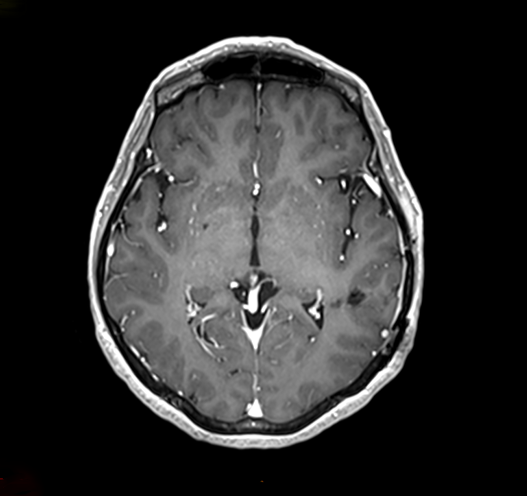 Cavernome ayant saigné après chirurgie