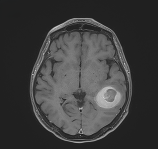 Cavernome ayant saigné avant chirurgie