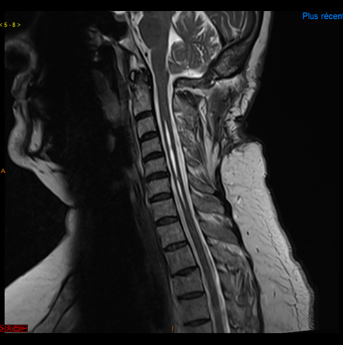 Malformation d’Arnold Chiari avec syringomyélie, post opératoire
