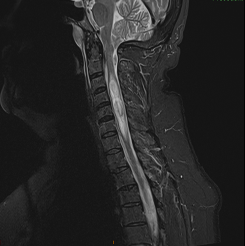 Malformation d’Arnold Chiari avec syringomyélie, préopératoire