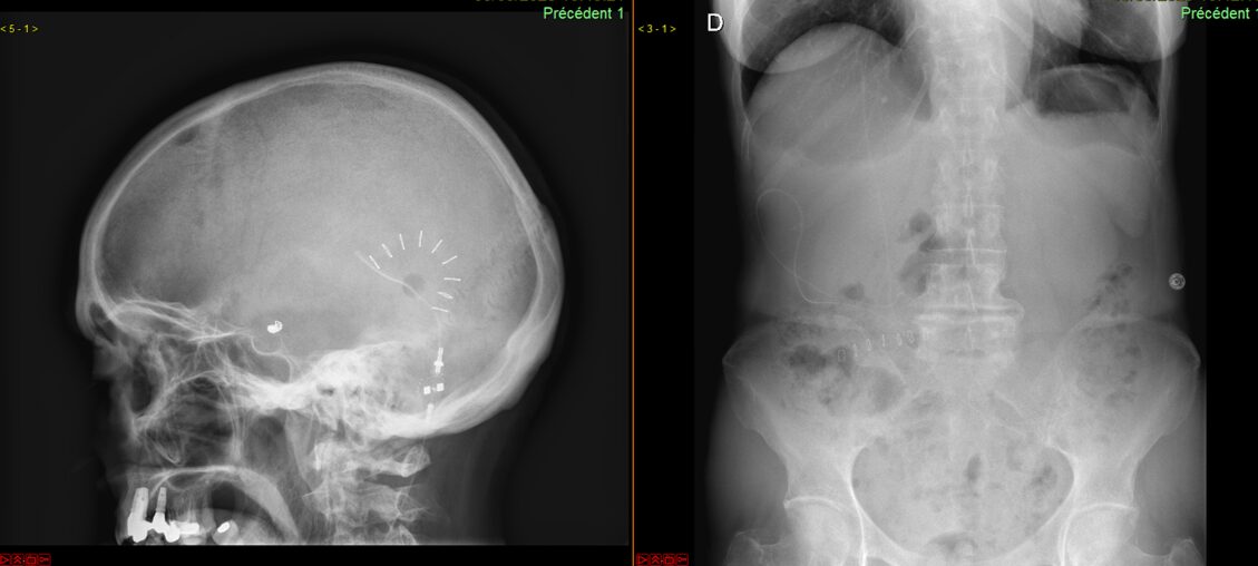 Dérivation ventriculo-péritonéale