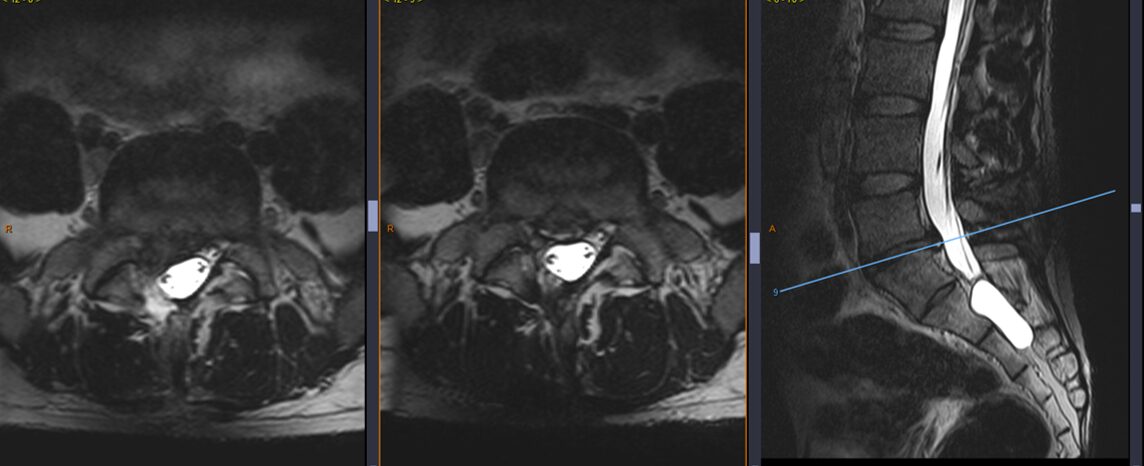 Hernie discale L5S1 avant et après chirurgie