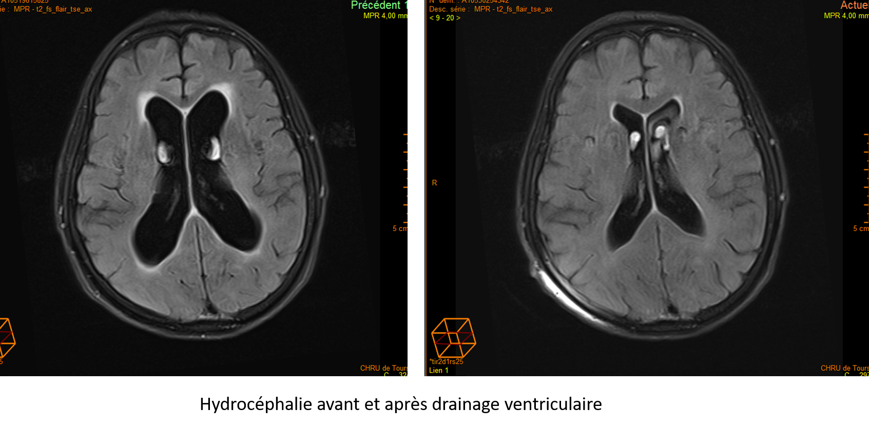 Hydrocéphalie avant et après drainage ventriculaire