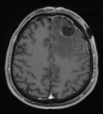IRM post-opératoire d’une lésion tumorale frontale gauche
