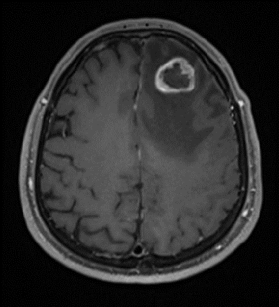 IRM préopératoire d’une lésion tumorale frontale gauche