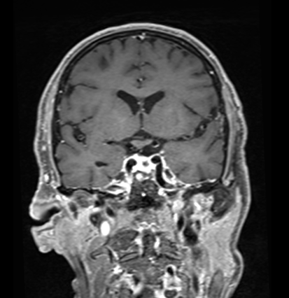 Macroadénome hypophysaire post-opératoire