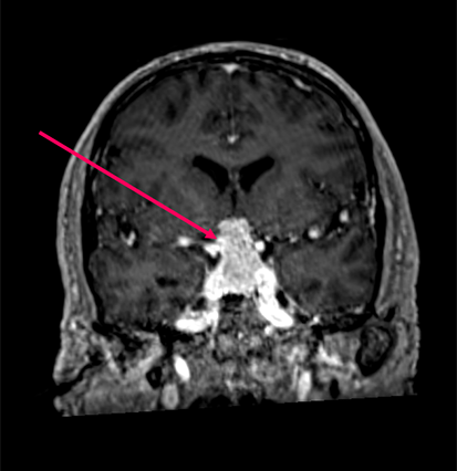 Macroadénome hypophysaire pré-opératoire