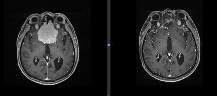 Méningiome ethmoïdal avant et après chirurgie