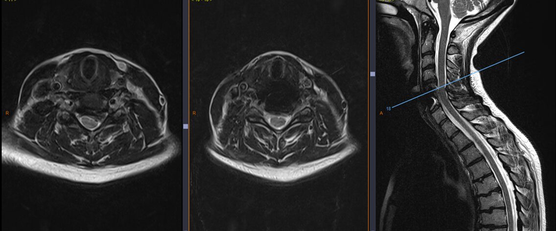 Hernie discale cervicale C5-C6 avant et après exérèse avec pose de prothèse discale cervicale