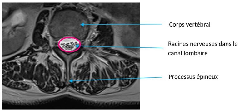 Canal Lombaire étroit