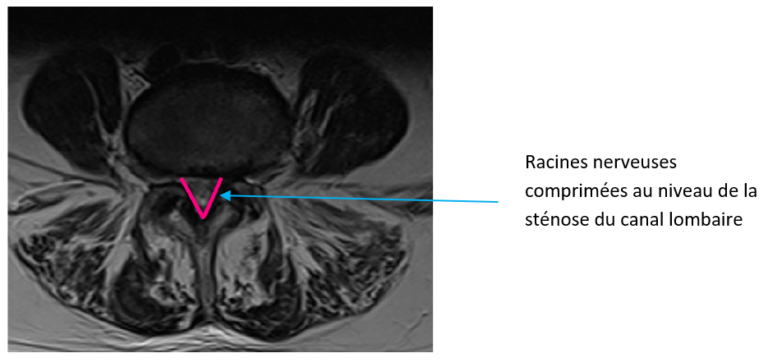 Canal Lombaire étroit - racines nerveuses comprimées