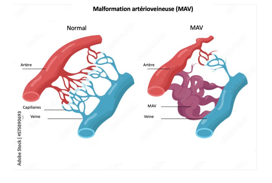 Malformation artérioveineuse
