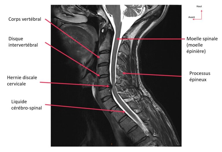 arthrodèse cervicale