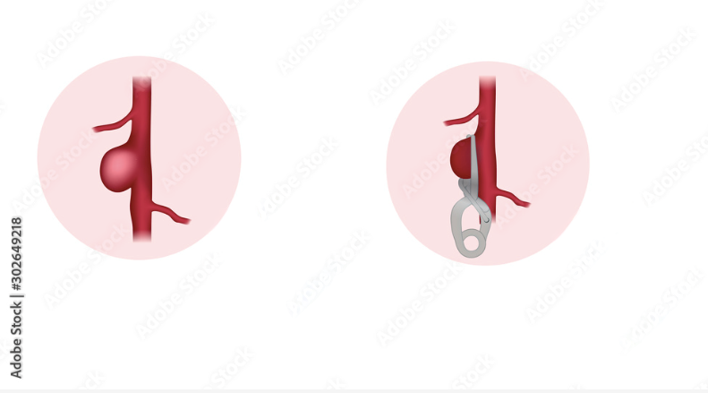 Clip d’un anévrisme intracrânien