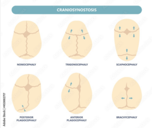 craniosténose