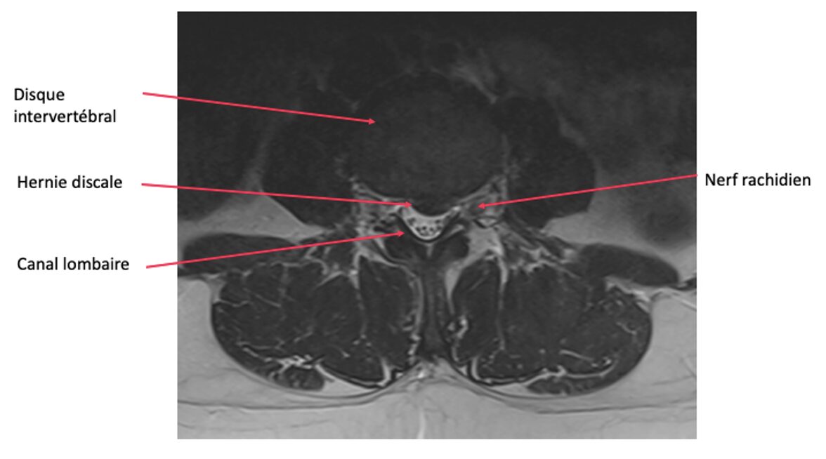 Hernie discale lombaire