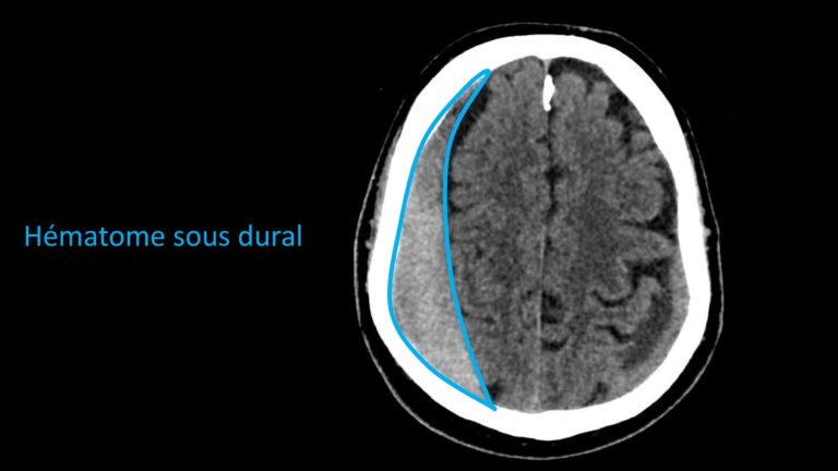 Figure 1 : Scanner cérébral mettant en évidence un hématome sous dural hémisphérique droit comprimant le cerveau du patient (entouré en bleu)