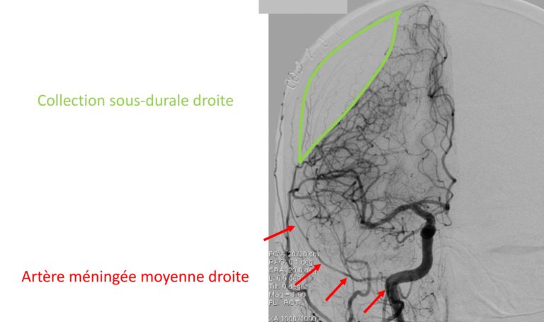 Figure 2 : Artériographie cérébrale d’un patient ayant un hématome sous-dural droitLa collection sanguine (contourée en vert) exerce un effet de masse sur le cerveau.L’artère méningée moyenne droite (flèches rouges) a été embolisée par le neuroradiologue.