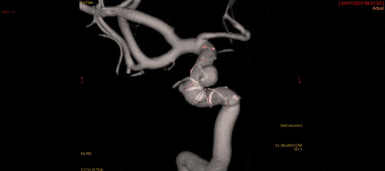 Anévrisme intracrânien traité par stent à diversion de flux (Flow Diverter)