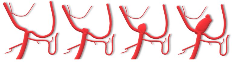 Formation et croissance d’un anévrisme intracrânien, localisé sur une bifurcation artérielle.Celui-ci réalise comme une « hernie » sur la paroi de l’artère.