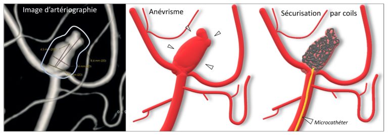 Anévrisme intracrânien, localisé sur une bifurcation artérielle.Celui-ci réalise comme une « hernie » sur la paroi de l’artère.À droite, schématisation d’une intervention d’embolisation réalisée par coils (mise en place de spires de platine dans le sac anévrismal)