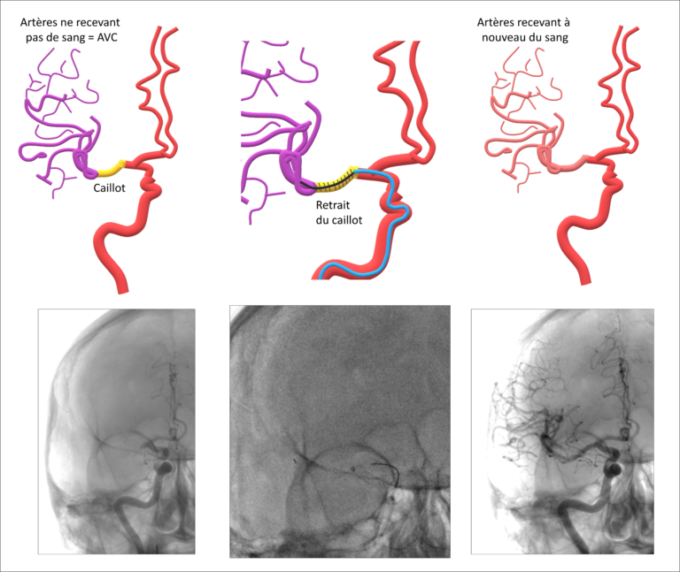 Thrombectomie