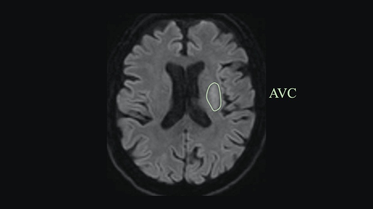 IRM cérébrale montrant un AVC