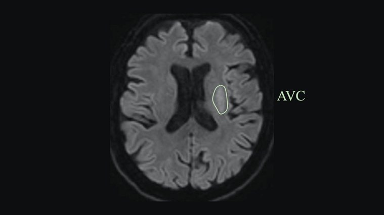 CHRU de Tours. Neuro-Radiologie Interventionnelle. L'AVC.