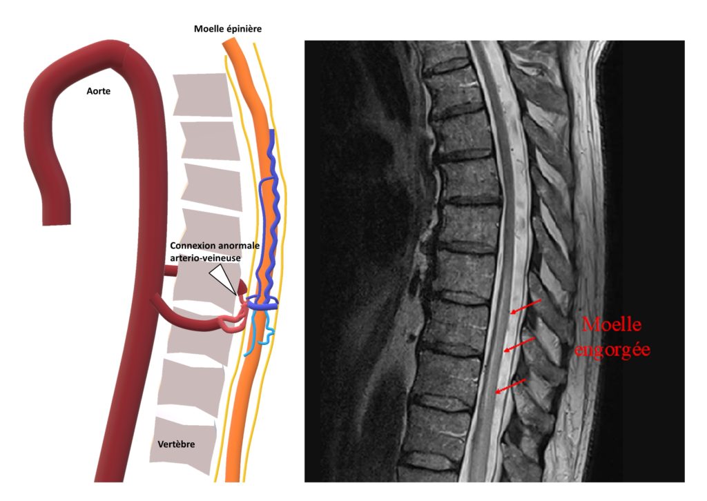 CHRU de Tours. NeuroRadiologie Interventionnelle. Lésions vasculaires