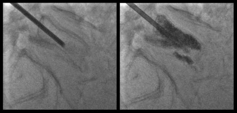 L’image de gauche montre le trocart en place dans le corps de la vertèbre ; L’image de droite montre le ciment qui a diffusé au sein du corps vertébral.